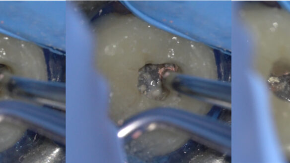 retratatamiento primer molar superior 16 zarc