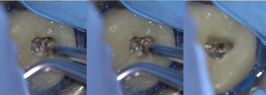 retratatamiento primer molar superior 16 zarc