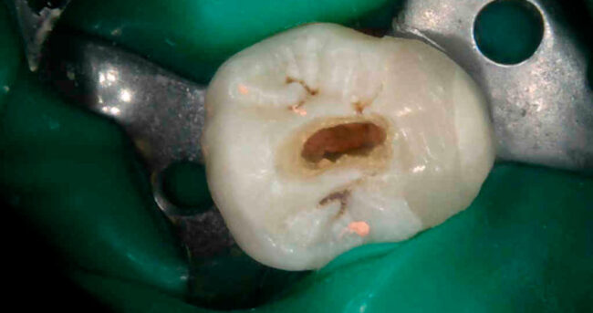 necrosis pulpar obturacion bifurcacion tercio medio