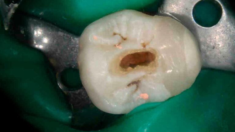 necrosis pulpar obturacion bifurcacion tercio medio