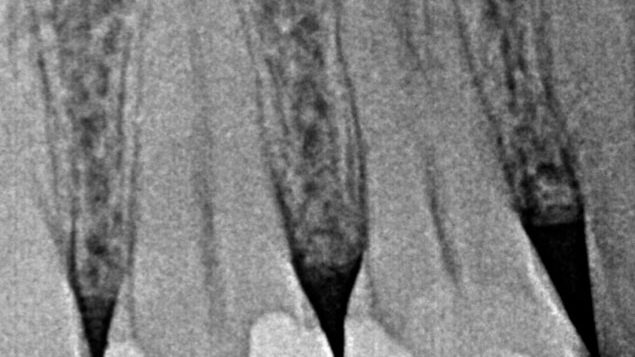 primer premolar superior de 3 conductos instrumentado con limas blueshaper