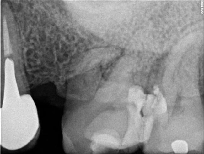 Radiografía de diagnóstico en la que se aprecia obturación profunda radiografia conductos curvos anatomia