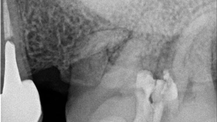 radiografia conductos curvos anatomia