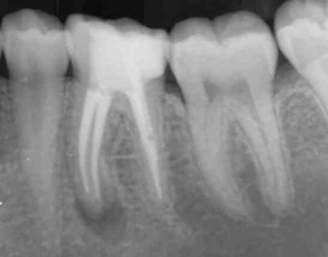 Radiografía preoperatorio Caso Clínico RetreatAll Purificación Varela periodontitis apical retratamiento de conductos retreatall
