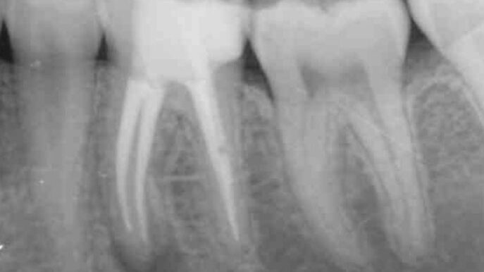 periodontitis apical retratamiento de conductos retreatall