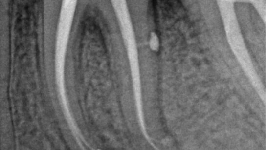 tratamiento de conductos con blueshaper