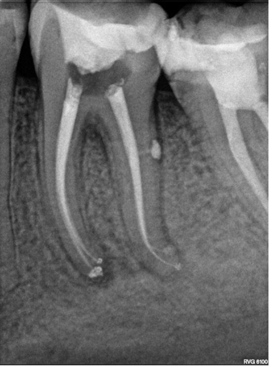 tratamiento de conductos con blueshaper