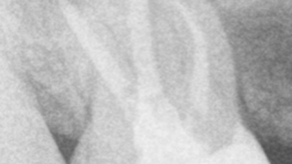 retratamiento con limas por la fractura de un instrumento