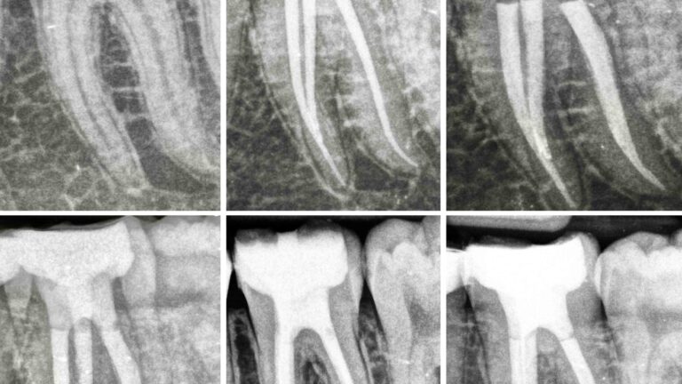 radiografías jose conde biopulpectomía en diente con pulpitis irreversible