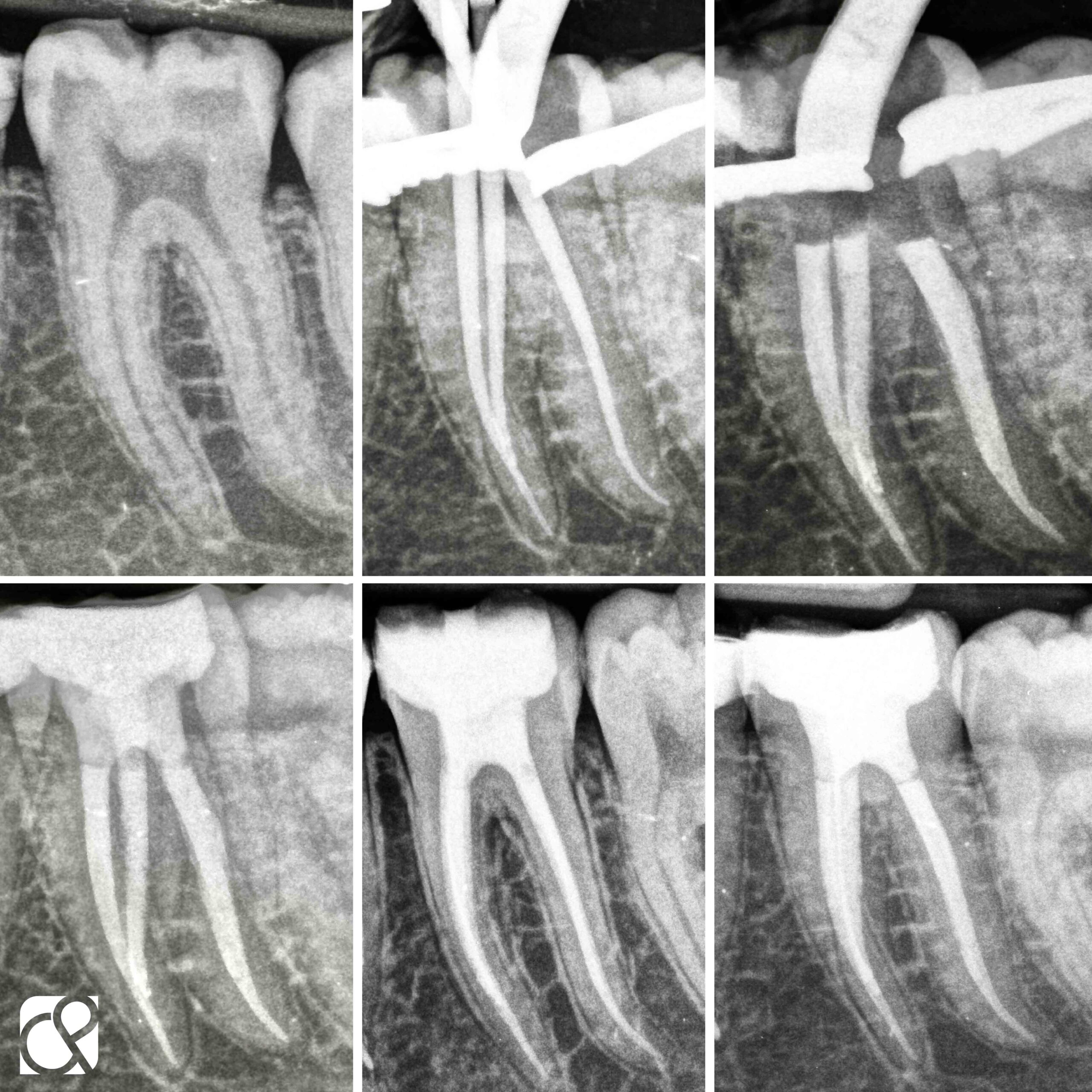 radiografías jose conde biopulpectomía en diente con pulpitis irreversible