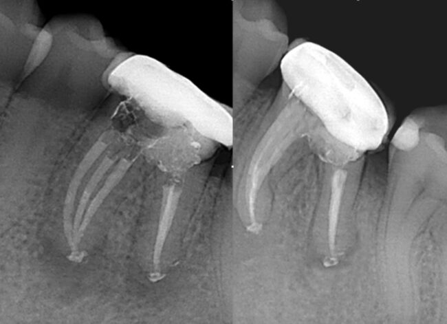 retratamiento con blueshaper