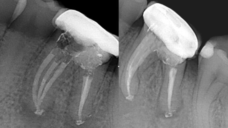 retratamiento con blueshaper