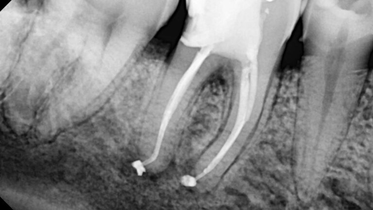 endodoncia en diente 4.6 con lima fracturada