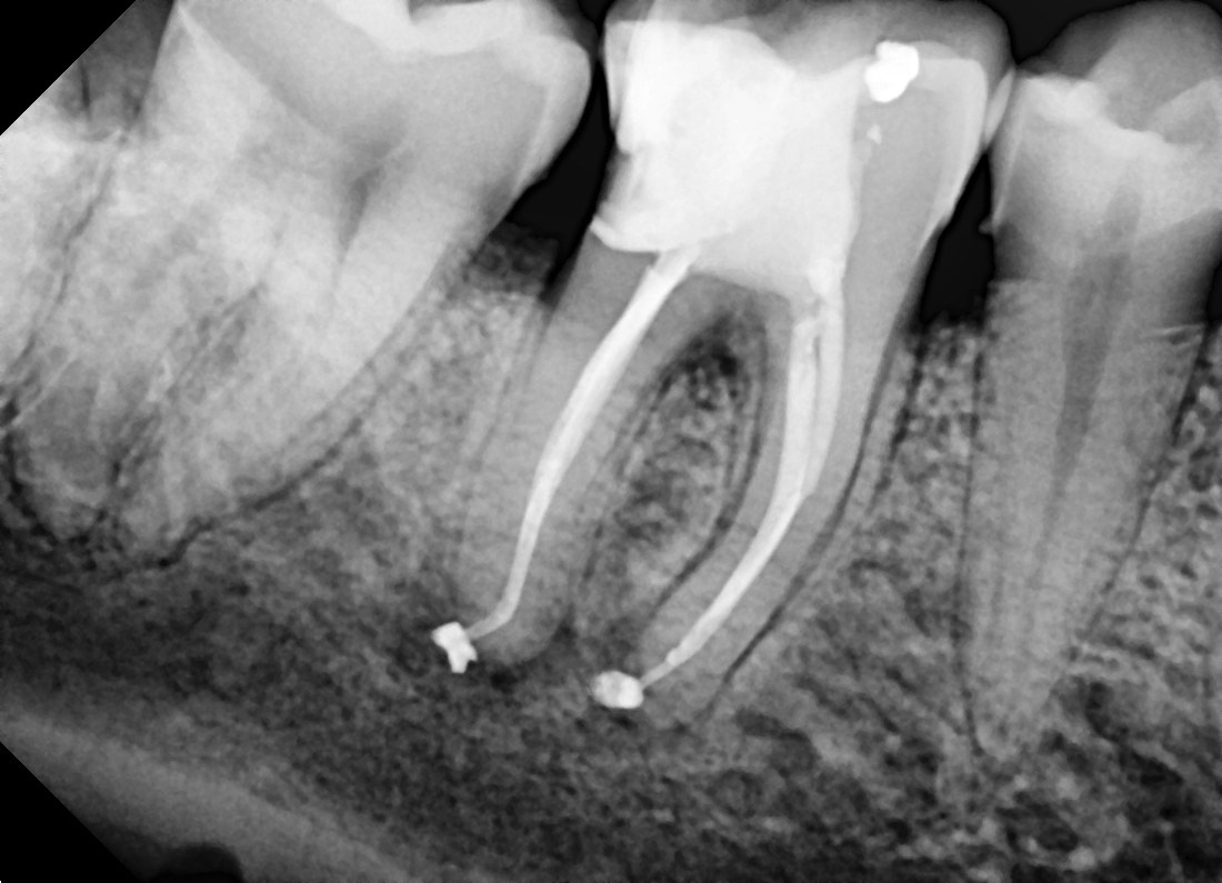 endodoncia en diente 4.6 con lima fracturada