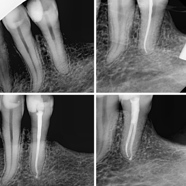 endodoncia diente 34 bifurcado