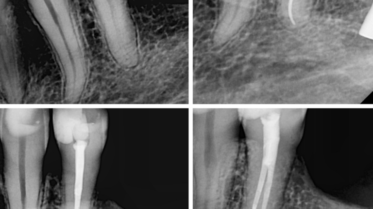 endodoncia diente 34 bifurcado