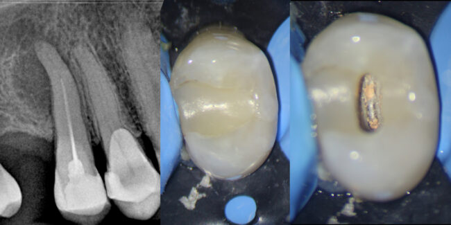 reendodoncia con limas RetreatAll y Z-Activator