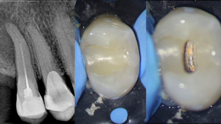 reendodoncia con limas RetreatAll y Z-Activator