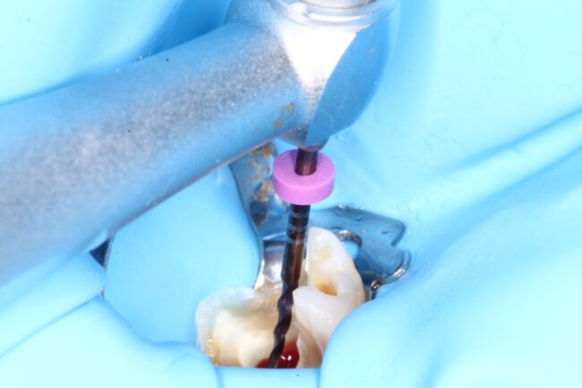 proceso periodontitis