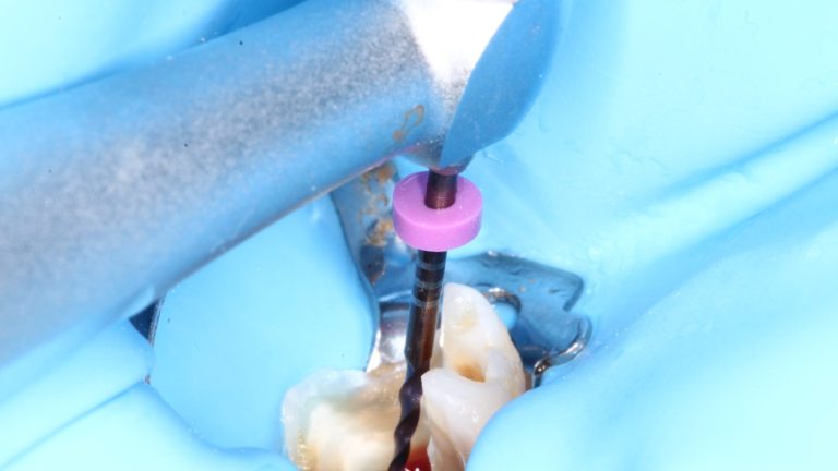 proceso periodontitis