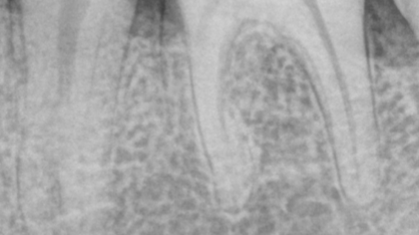 Molar 35 rx preoperatoria