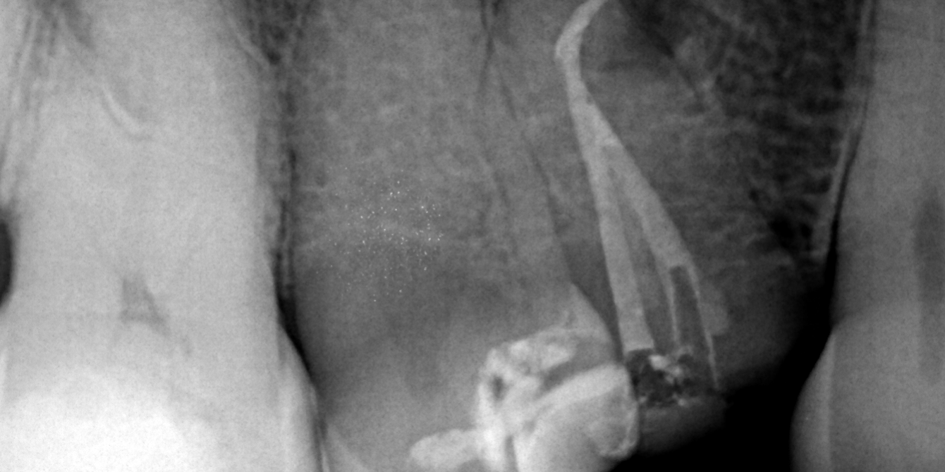 Caso clínico de la Dra. Alessandra Baasch instrumentado con BlueShaper®️+ ApicalShaper®️