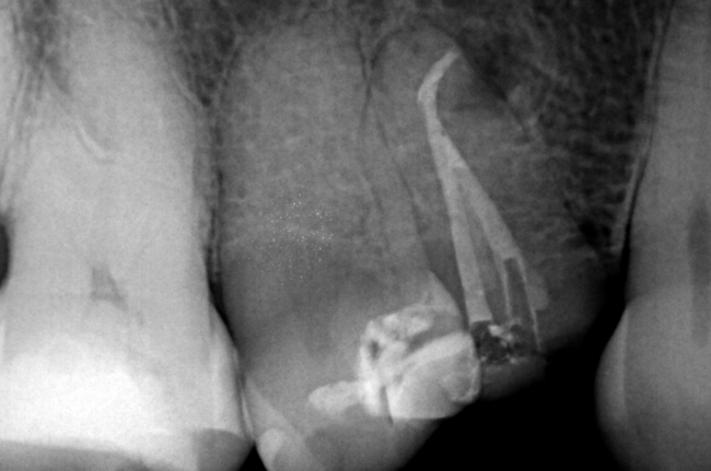 Caso clínico de la Dra. Alessandra Baasch instrumentado con BlueShaper®️+ ApicalShaper®️