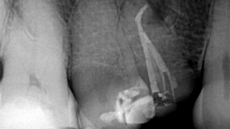 Caso clínico de la Dra. Alessandra Baasch instrumentado con BlueShaper®️+ ApicalShaper®️