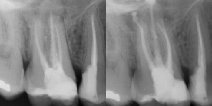 Portada de retratamiento del doctor Noe Hernández con Excalibur y NeoSealer Flo