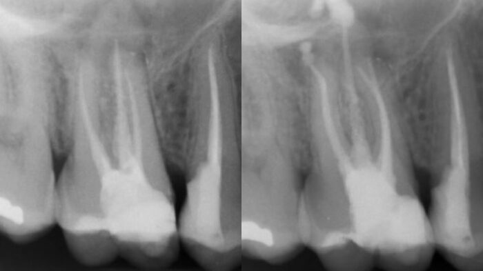 Portada de retratamiento del doctor Noe Hernández con Excalibur y NeoSealer Flo
