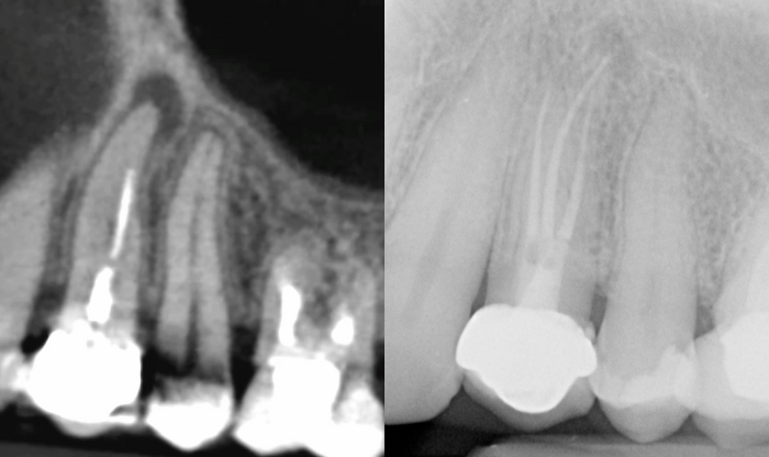 En Zarc, nuestra misión es trascender fronteras para ofrecer una cobertura internacional incomparable en el campo de la endodoncia.